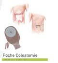 Poche Colostomie - Diamètre : De 20 à 60 mm